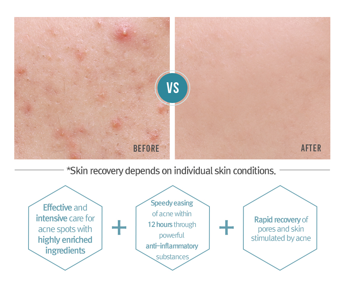 ACNE Spot Cream 15ml / 0.50 Fl. Oz