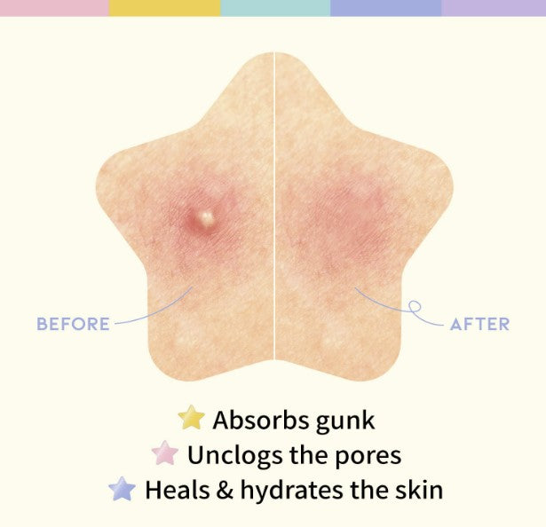 Star Spot Acne / Pimple Patch 80 Counts