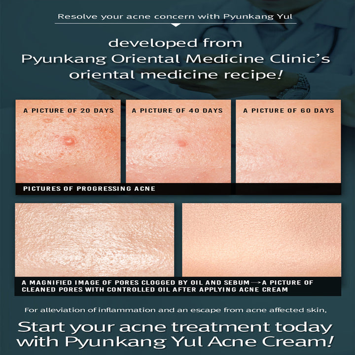 Acne Cream 1.69 fl. oz. / 50ml