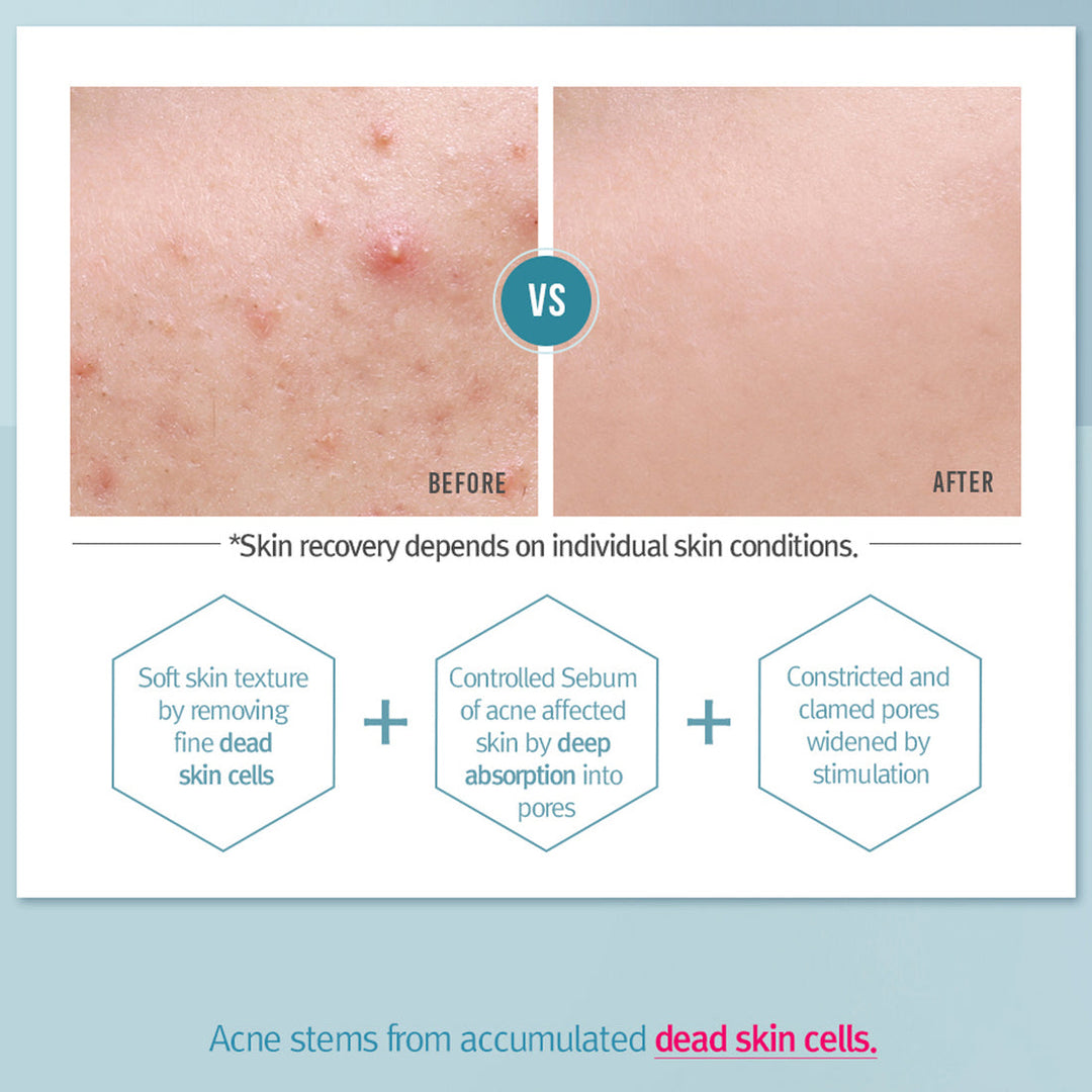 Acne Toner 150ml / 5.07 Fl. Oz.