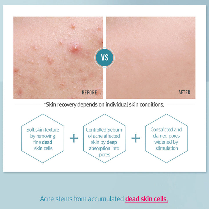 Acne Toner 150ml / 5.07 Fl. Oz.