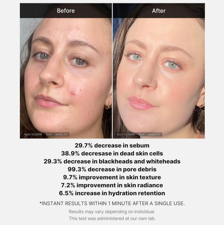Red Acne Succinic Acid Peel Serum 40ml / 1.41 fl. oz.